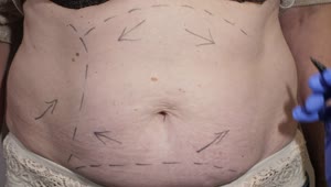 Download Stock Video Marking Abdomen Before Liposuction Surger Animated Wallpaper