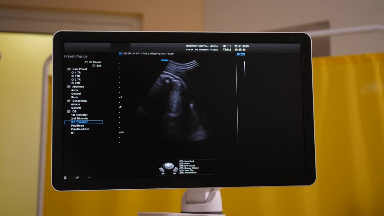 Download   Stock Footage Ultrasound Scan On A Monitor Live Wallpaper